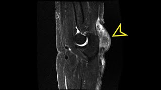 Elbow MRI Olecranon Bursitis [upl. by Aid]