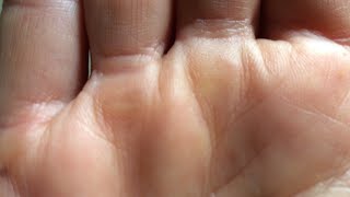 how to get rid of calluses on your hands from lifting [upl. by Rieth740]