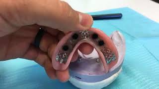 What is an Implant Denture Tryin [upl. by Adierf]