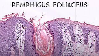 Pemphigus foliaceus autoimmune skin blister immunobullous disease in pemphigus vulgaris family [upl. by Kred]