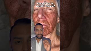 Plasma Fibroblast Vs AgeJet Plasma Which One Dr Somji Explains [upl. by Aliber]