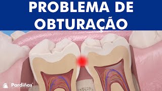 Restauração dental – Problema de obturação © [upl. by Aicil78]