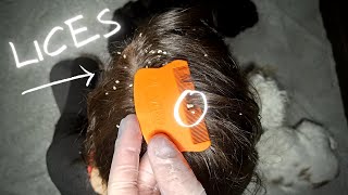 ASMR Lice removal NOTalking Real person ASMR Scalp Check  Lice Check 💆 [upl. by Akima]