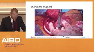 IBD Surgery Debate 1 Ileocecal Crohns disease [upl. by Saoj]