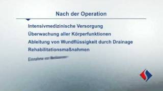 Rekonstruktion und Ersatz der Aortenklappe Teil 8  Nach der Operation [upl. by Ailliw997]