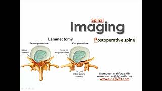 Spine post operative imaging PT Prof Mamdouh Mahfouz [upl. by Nebeur]