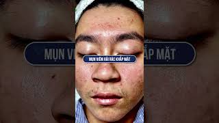 The Acne Treatment Secret HHV Clinic amp Hien Van Spa Revealed [upl. by Chaille]