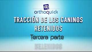 Tracción de los caninos retenidos Tercera parte [upl. by Nauqal123]