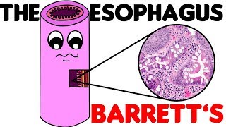 Esophagus Histology  3 Barretts Esophagus [upl. by Edrea]