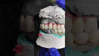 screw retained dmlsdentalimplanttitaniumdentalclinic [upl. by Slrahc]