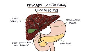 Primary Sclerosing Cholangitis Visual Explanation for Students [upl. by Dilisio]