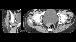 Trochanteric bursitis  CT findings [upl. by Jotham]