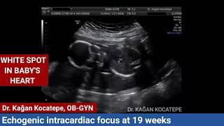 Echogenic Focus in Heart on Ultrasound What to do  Dr Sahil Chuadhry [upl. by Lenod]