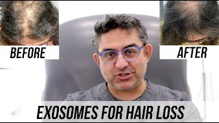 Exosomes for Hair Regrowth [upl. by Eillac535]