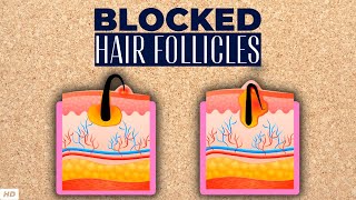 Blocked Hair Follicle – Everything You Need To Know [upl. by Herrod]