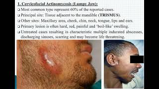 LGT 81  Actinomyces spp Actinomycosis Nocardia amp Mycetoma [upl. by Jandy]