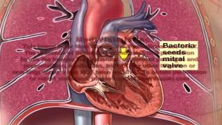 Bacterial Endocarditis [upl. by Nerag]