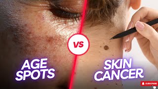 AGE SPOTS VS SKIN CANCER How To Spot The DIFFERENCE [upl. by Godfry]