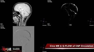 Cine MR amp Q FLOW CSF Circulation [upl. by Aurie]