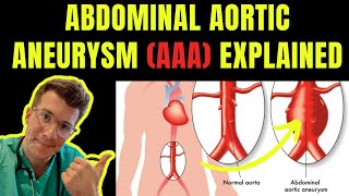 Doctor explains ABDOMINAL AORTIC ANEURYSM AAA  Symptoms risk factors treatment screening [upl. by Witty550]