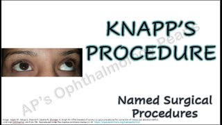 Knapp’s procedure  Named Surgical Procedures [upl. by Ahsit]