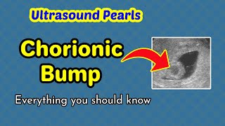 Ultrasound Pearls Chorionic Bump [upl. by Rebmat]