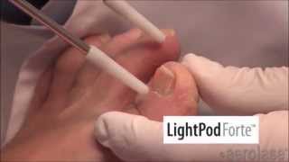 Treatment of Nails with LightPod Forte [upl. by Groscr609]