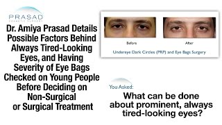 What Causes Tired Eyes in Young People and Eye Puffiness Treatment Options [upl. by Virnelli]