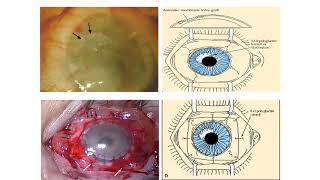 Reconstruction de Surface Oculaire et Insuffisance Limbique  E Gabison [upl. by Deach]