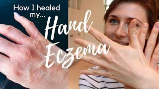 Hand Eczema Treatment Natural Cure  7 Tips How I Healed My Hand ECZEMA  HEAL ECZEMA NATURALLY [upl. by Howie]