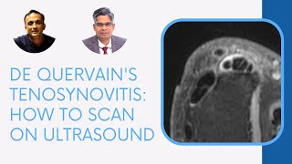 DE QUERVAINS TENOSYNOVITIS HOW TO SCAN ON ULTRASOUND [upl. by Anaujal]