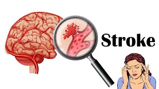 Stroke  Types Causes Risk Factors Signs amp Symptoms [upl. by Carder]