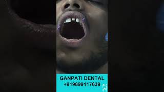 Tooth Cap Transformation  दांतों की कैपिंग [upl. by Felix431]