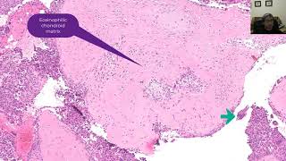 Chondroblastoma with differential diagnosis [upl. by Corin]