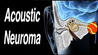 Acoustic Neuroma Causing One Sided Hearing Loss [upl. by Macmahon103]