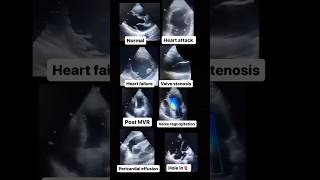 Echocardiogram NORMAL vs ABNORMAL radiology cardiology [upl. by Halian]