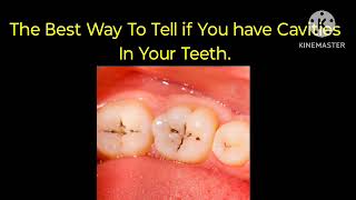 How to know if you have Cavities between teeth [upl. by Atcliffe]