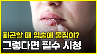 헤르페스HSV 예방 방법과 치료 방법은 아는 만큼 보인다 [upl. by Enej578]