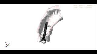 Medtronic CoreValve simulation [upl. by Hnahk696]