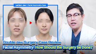 ENJPTH SUB Double Jaw Surgery Case Review Facial Asymmetry How Should the Surgery be Done [upl. by Vedette]