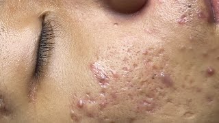 ACNE TREATMENT VU QUYNH MI Acne On Boys Nose 2024 [upl. by Nort]