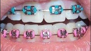 MY BRACES 101 updatessss [upl. by Neros447]