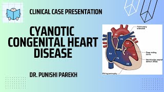 Clinical Case presentation on Cyanotic Congenital Heart disease [upl. by Silletram]