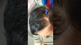 Dermapen best for Hair Loss control Hair growth Treatment [upl. by Yssak677]