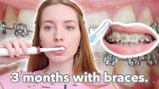 BRACES  3 month update  dental routine [upl. by Toscano89]