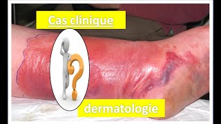 Cas clinique quotdermatologie quot [upl. by Hendel15]