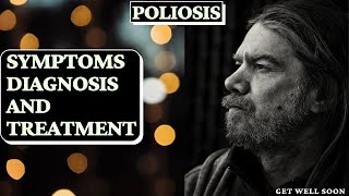 Poliosis Symptoms Diagnosis and Treatment [upl. by Bithia]