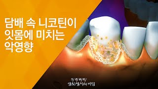 담배 속 니코틴이 잇몸에 미치는 악영향  2010318325회 방송소리 없는 잇몸의 고통 치주병 [upl. by Brag]