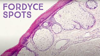 Fordyce Spots quotoil glandsquot under the microscope Montgomery tubercles Tyson glands sebaceous [upl. by Notna339]