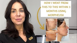 Is Morpheus8 worth it Before amp After of Morpheus8 Radiofrequency amp Microneedling Review [upl. by Airamana]